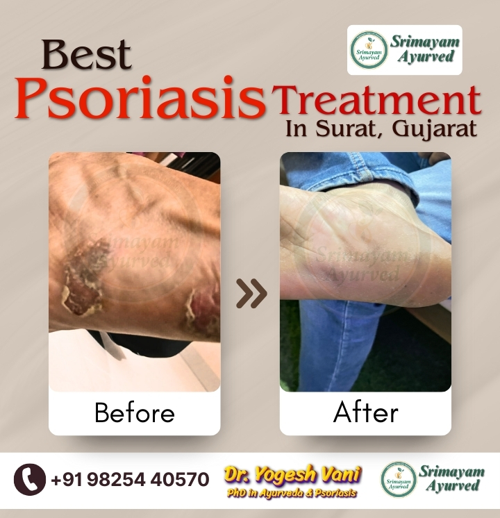 Eczema Treatment